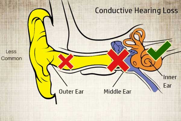 Conductive-Hearing-Loss
